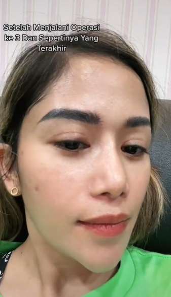 3 Kali Operasi Plastik, Bentuk Hidung Terbaru Farida Nurhan Jadi Sorotan
