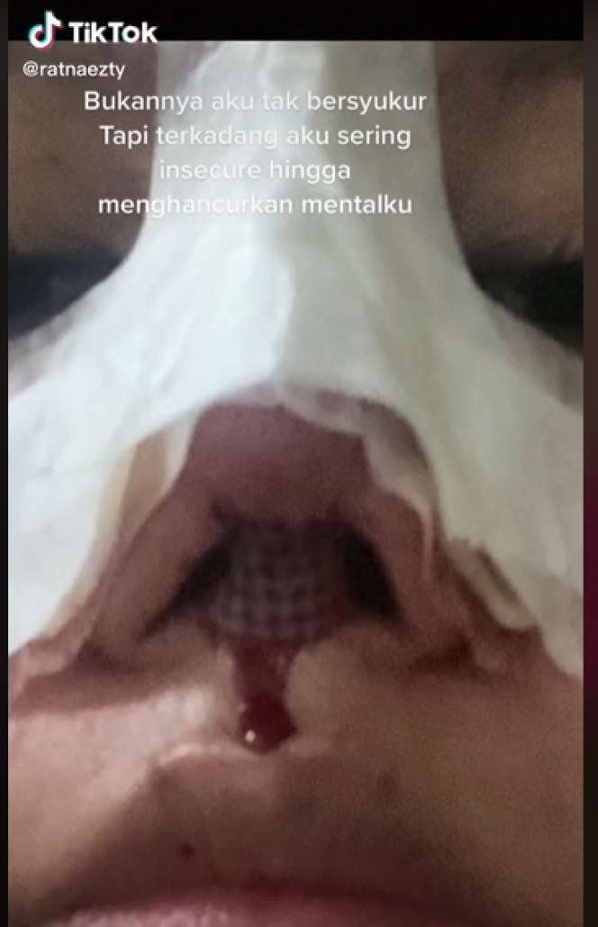 Potret Wanita yang Lakukan Oplas karena Insecure, Transformasinya Bikin Melongo!