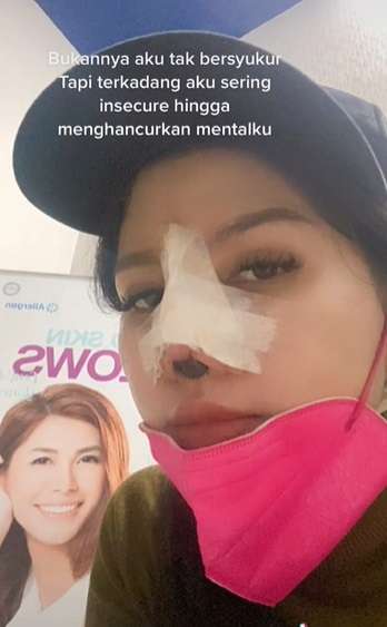 Potret Wanita yang Lakukan Oplas karena Insecure, Transformasinya Bikin Melongo!