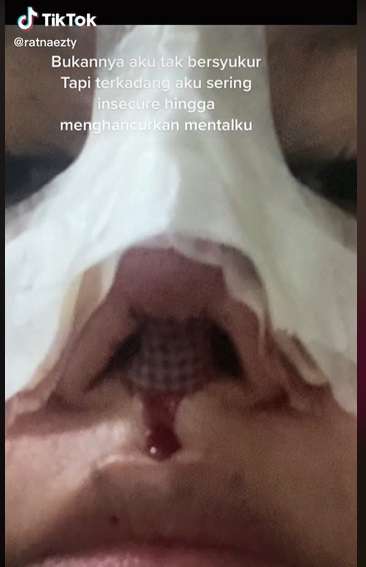 Potret Wanita yang Lakukan Oplas karena Insecure, Transformasinya Bikin Melongo!