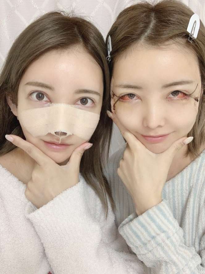 10 Potret Si Kembar yang Oplas Demi Terlihat Identik, Netizen Salfok Foto Before-nya: Beda Banget!
