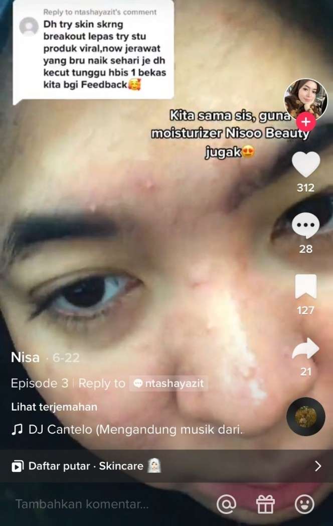 Ingat Wanita Berjerawat yang Dimodali Pacar Rp6,5 Juta Perminggu Agar Cantik? Begini Nasibnya Sekarang