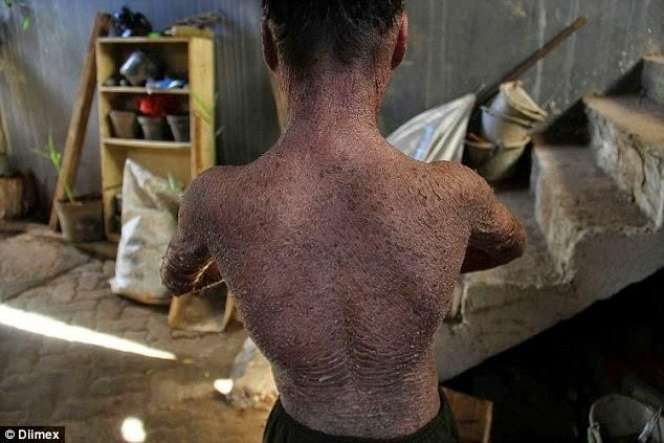 Ingat Ari Wibowo `Bocah Ular` yang Viral Tahun 2014? Sekujur Tubuh Bak Penuh Sisik, Begini Kondisinya Sekarang