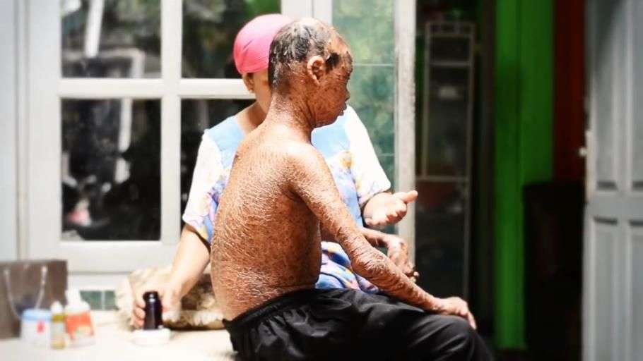Ingat Ari Wibowo `Bocah Ular` yang Viral Tahun 2014? Sekujur Tubuh Bak Penuh Sisik, Begini Kondisinya Sekarang