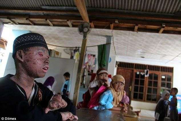 Ingat Ari Wibowo `Bocah Ular` yang Viral Tahun 2014? Sekujur Tubuh Bak Penuh Sisik, Begini Kondisinya Sekarang