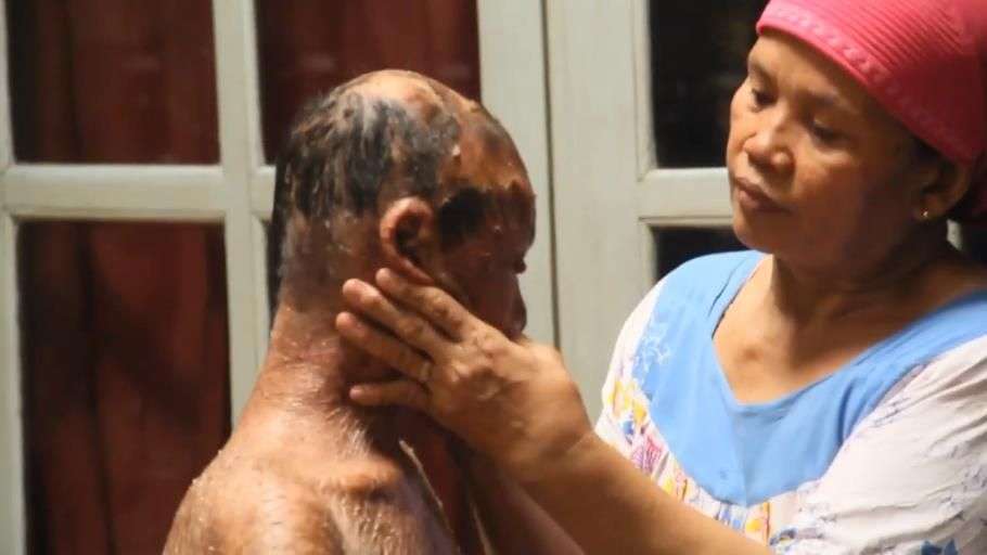Ingat Ari Wibowo `Bocah Ular` yang Viral Tahun 2014? Sekujur Tubuh Bak Penuh Sisik, Begini Kondisinya Sekarang
