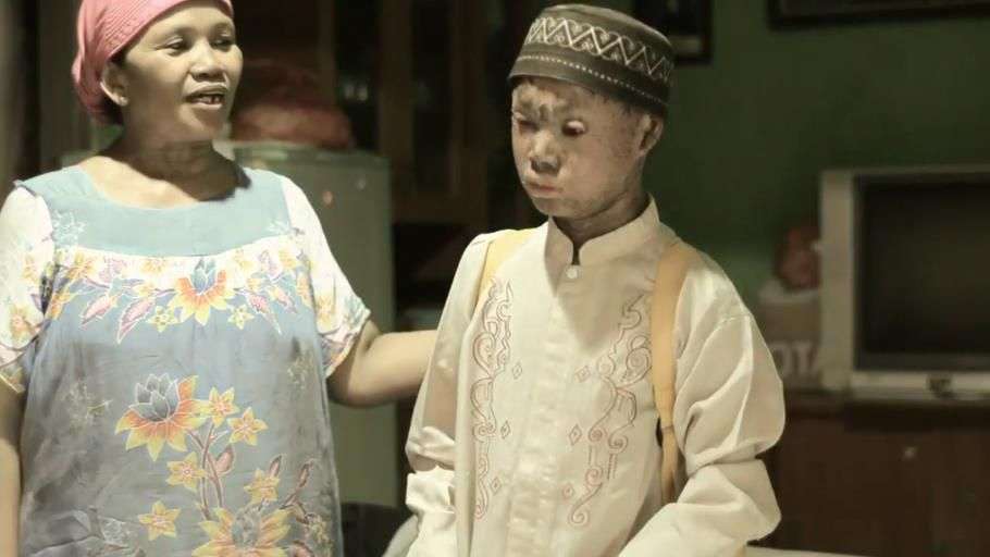 Ingat Ari Wibowo `Bocah Ular` yang Viral Tahun 2014? Sekujur Tubuh Bak Penuh Sisik, Begini Kondisinya Sekarang