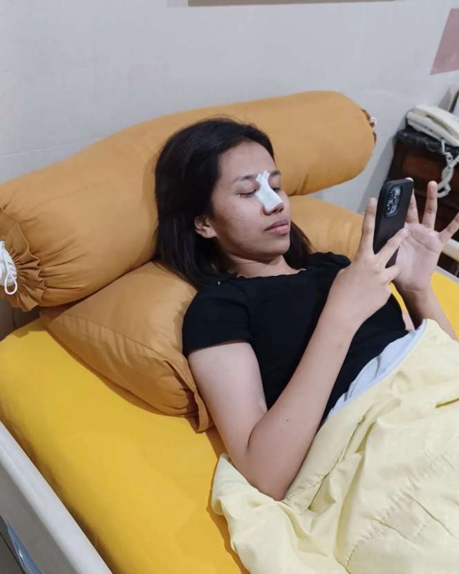 Potret Mayang Putri Doddy Sudrajat Oplas Hidung, Sempat Tidak Boleh Berbicara