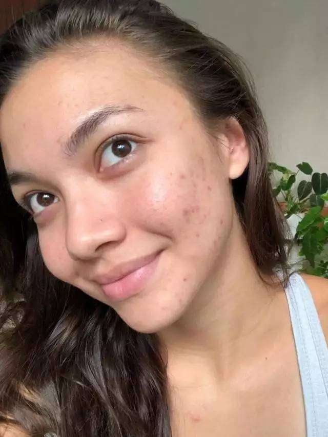 Potret Seleb Pamer Foto Selfie Wajah Penuh Jerawat