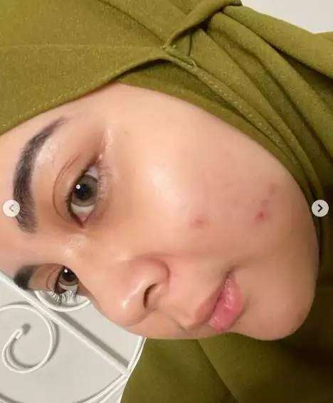 Potret Seleb Pamer Foto Selfie Wajah Penuh Jerawat