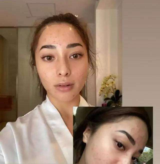 Potret Seleb Pamer Foto Selfie Wajah Penuh Jerawat