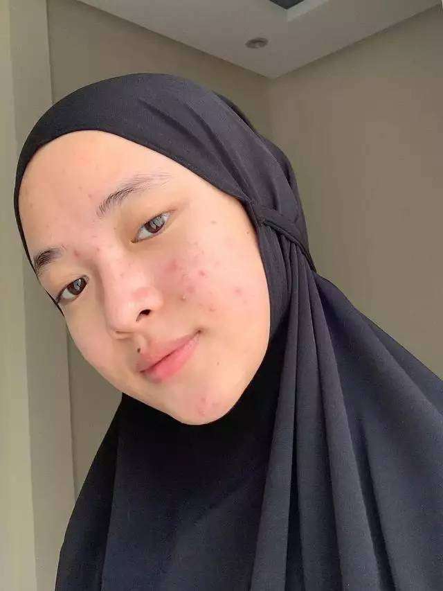 Potret Seleb Pamer Foto Selfie Wajah Penuh Jerawat