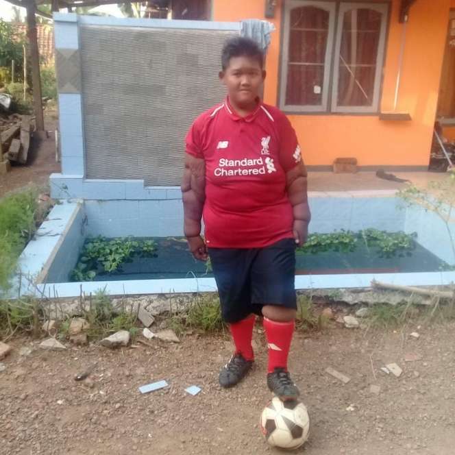 Masih Ingat Arya Permana Bocah Viral Berbobot 190 Kg? Penampilannya Berubah Drastis Usai Operasi & Diet, Bikin Pangling!