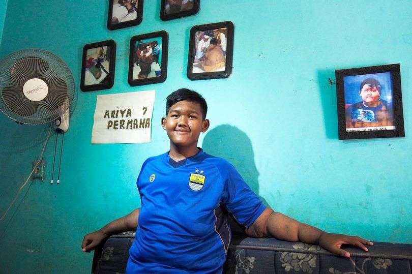 Masih Ingat Arya Permana Bocah Viral Berbobot 190 Kg? Penampilannya Berubah Drastis Usai Operasi & Diet, Bikin Pangling!