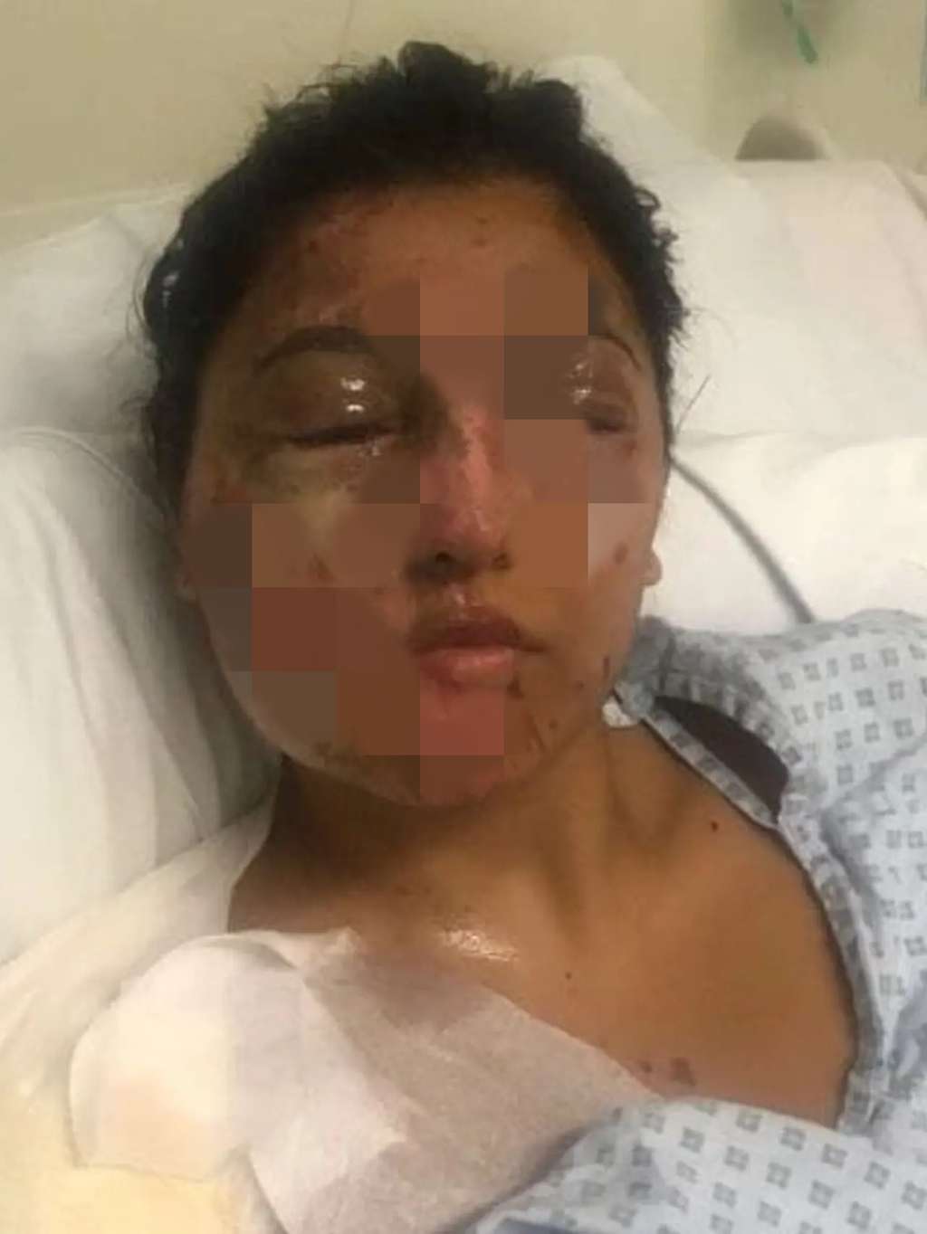 Ingat Artis Cantik yang Disiram Air Keras di Hari Ulang Tahunnya? Wajahnya Dulu Meleleh & Hancur, Penampilannya Kini Bikin Pangling