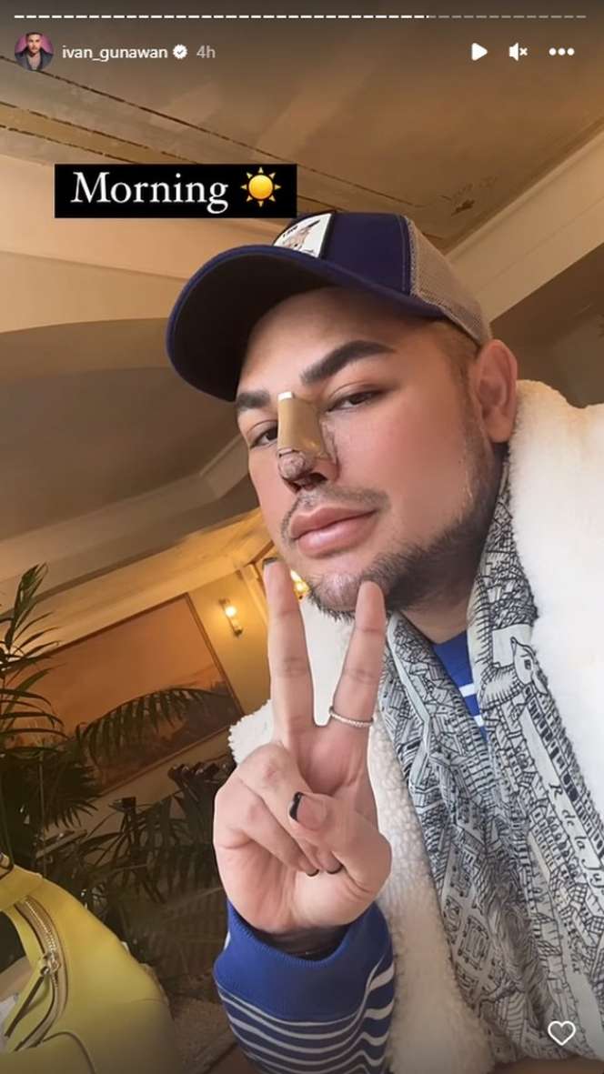 Potret Ivan Gunawan Pamer Hidung Baru Usai Oplas di Turki, Hasilnya Beda Banget!