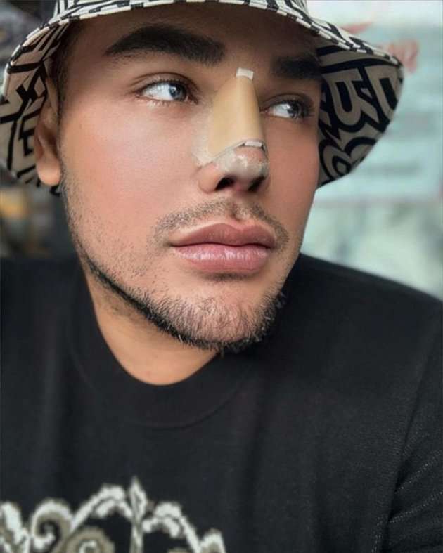 Potret Ivan Gunawan Pamer Hidung Baru Usai Oplas di Turki, Hasilnya Beda Banget!