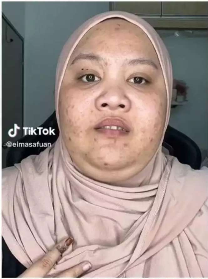 10 Transformasi Makeup Wanita Berjerawat Parah, Jadi Cantik Tirus Bak Boneka Barbie, Bikin Pangling!