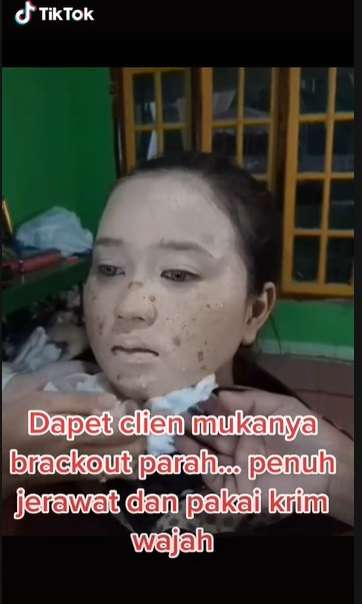 Potret Transformasi Makeup Pengantin yang Alami Jerawat Parah, Hasil Riasannya Bikin Melongo!