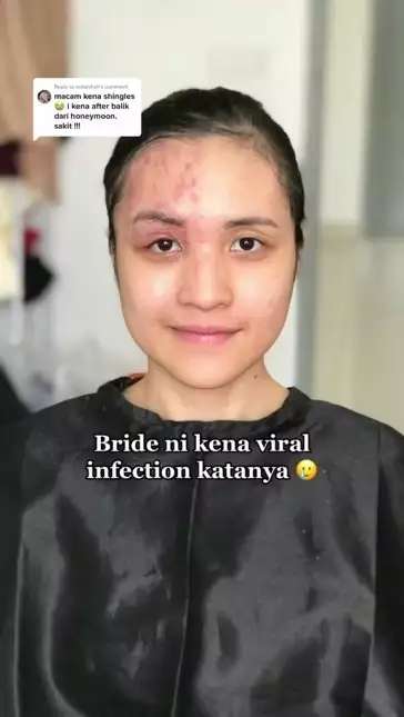 Potret Pengantin Wajahnya Terkena Infeksi Dirias MUA, Hasilnya Bikin Pangling, Mulus Bak Barbie Hidup!