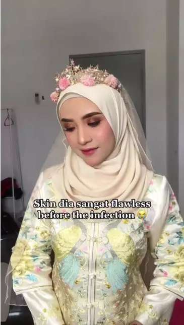 Potret Pengantin Wajahnya Terkena Infeksi Dirias MUA, Hasilnya Bikin Pangling, Mulus Bak Barbie Hidup!