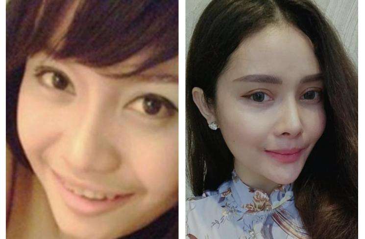 Beda Banget dan Manglingin! Foto Artis Sebelum dan Sesudah Oplas