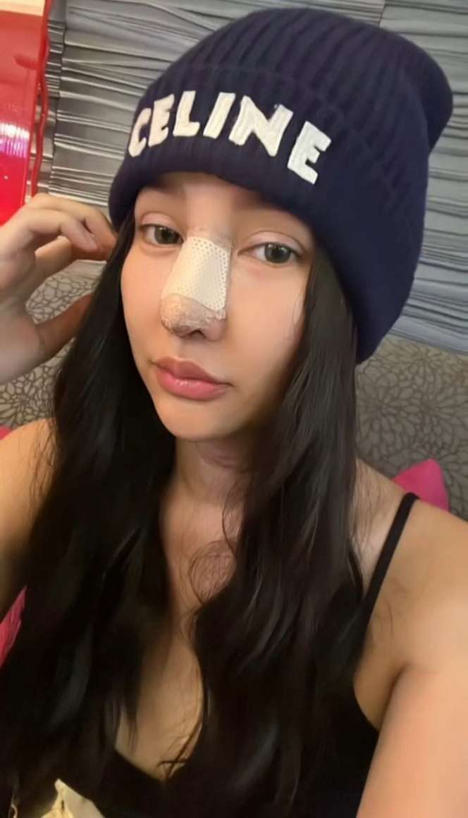 Disebut Mirip Hidung Pinocchio, Potret Terbaru Lucinta Luna Jalani Operasi Plastik Lagi di Thailand