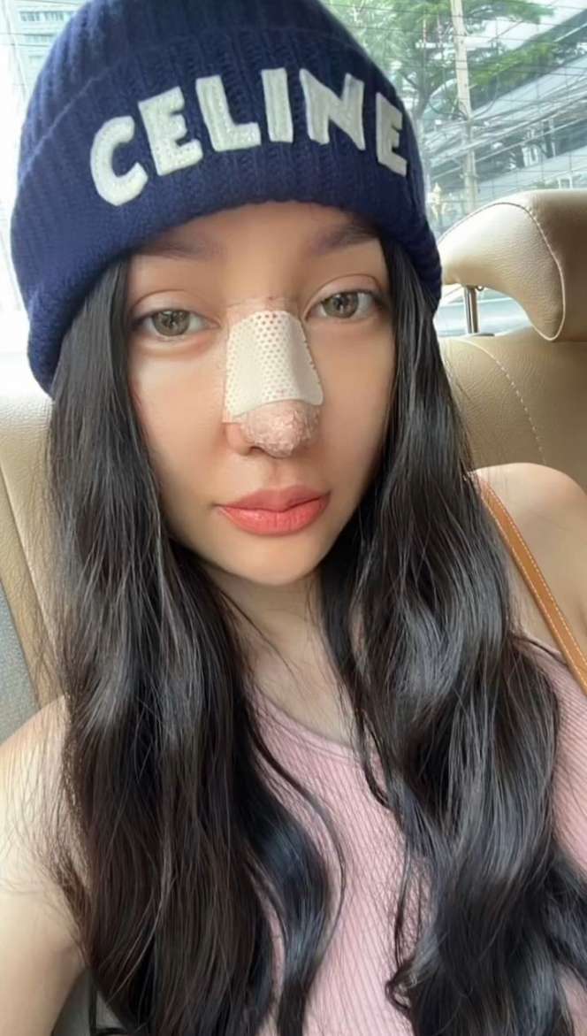 Disebut Mirip Hidung Pinocchio, Potret Terbaru Lucinta Luna Jalani Operasi Plastik Lagi di Thailand