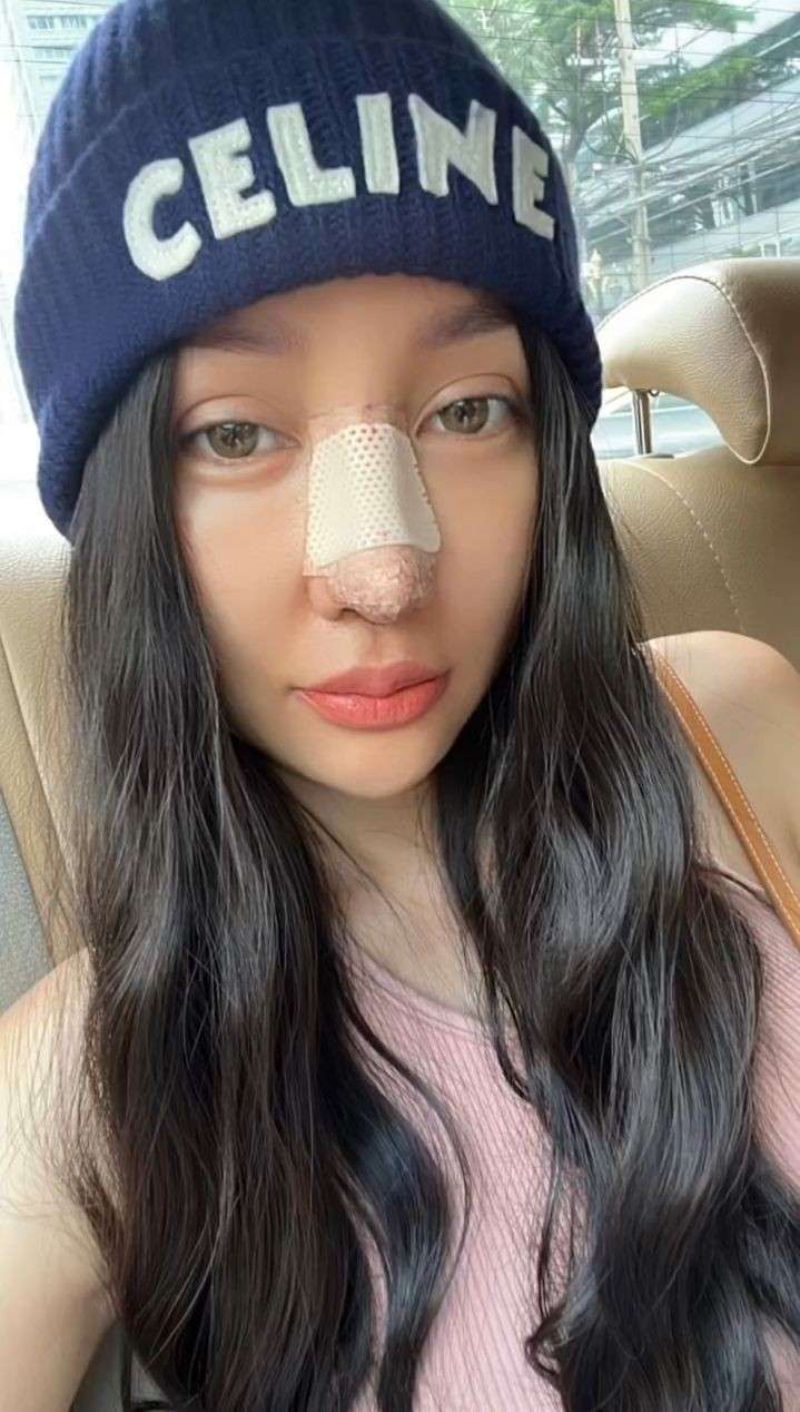 Disebut Mirip Hidung Pinocchio, Potret Terbaru Lucinta Luna Jalani Operasi Plastik Lagi di Thailand