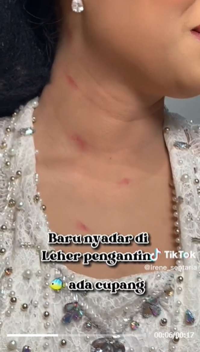 Viral MUA Bagikan Tips Tutupi Ruam Merah di Leher Pengantin, Netizen: Digigit Nyamuk Berkumis!