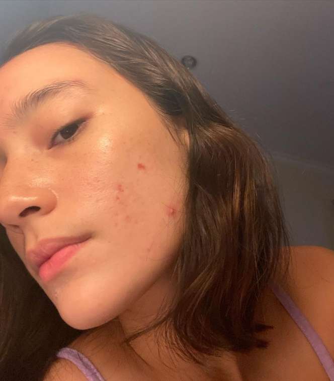 Potret Tatjana Saphira Pede Pamerkan Wajah Berjerawat