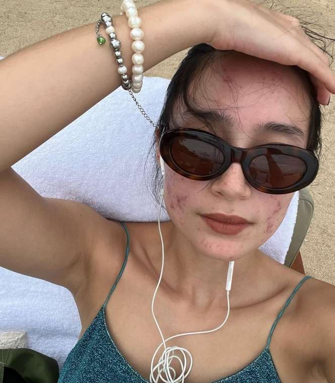 Potret Tatjana Saphira Pede Pamerkan Wajah Berjerawat