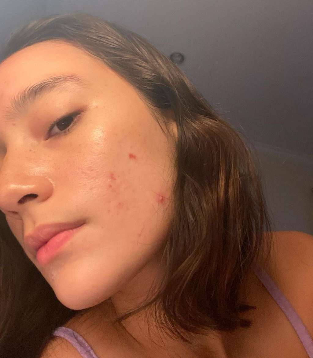 Potret Tatjana Saphira Pede Pamerkan Wajah Berjerawat