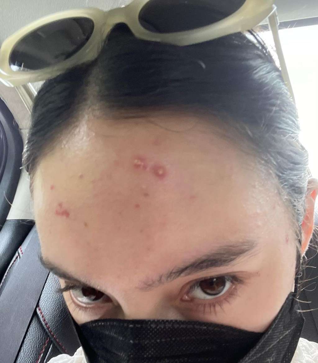 Potret Tatjana Saphira Pede Pamerkan Wajah Berjerawat