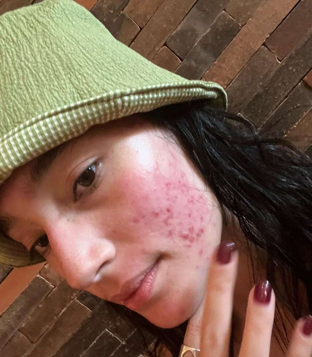 Potret Tatjana Saphira Pede Pamerkan Wajah Berjerawat