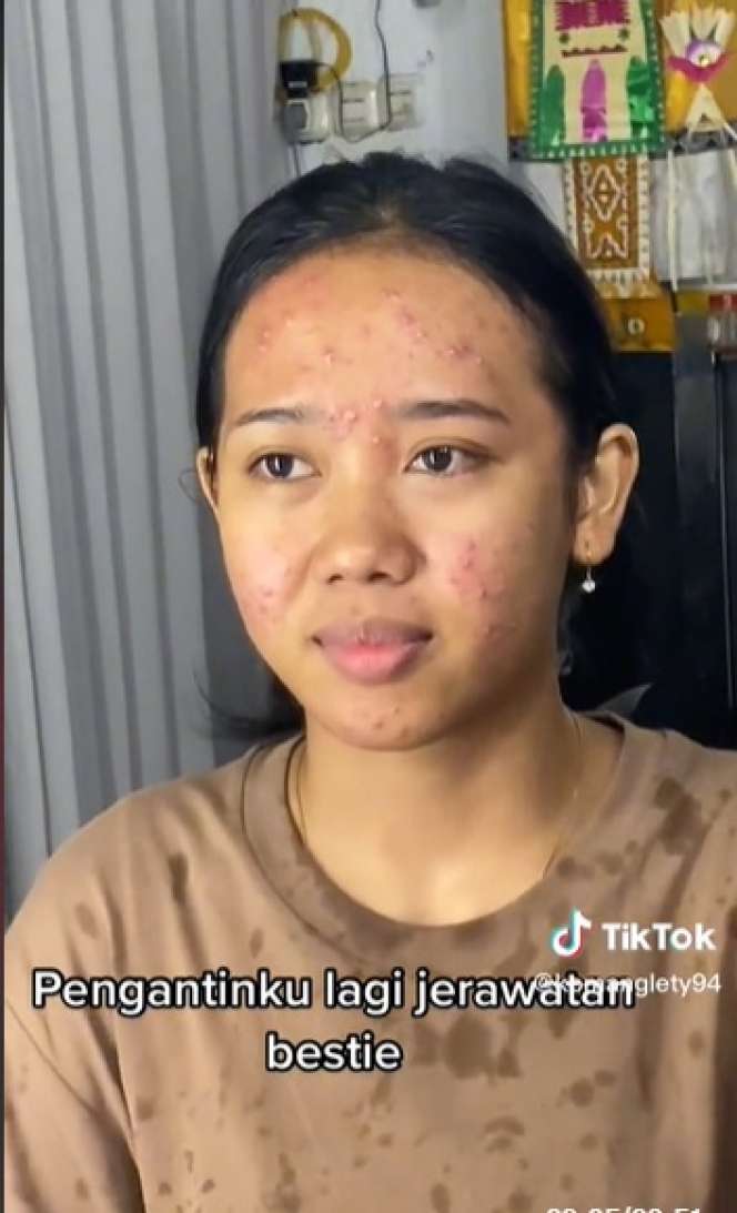 Potret Transformasi Makeup Pengantin yang Alami Jerawat Parah, Awalnya Bikin Deg-degan, Endingnya Malah Bikin Syok!