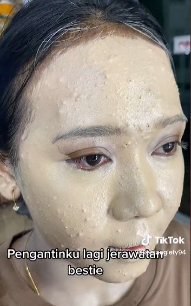 Potret Transformasi Makeup Pengantin yang Alami Jerawat Parah, Awalnya Bikin Deg-degan, Endingnya Malah Bikin Syok!