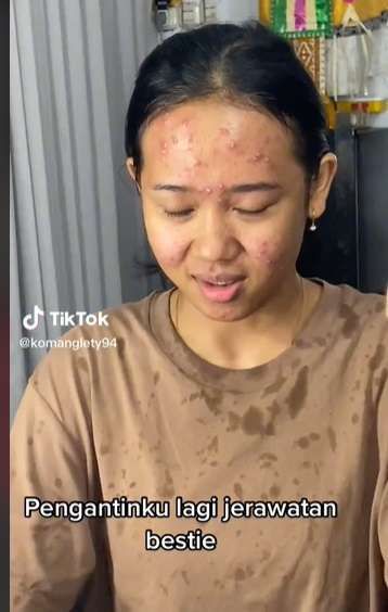 Potret Transformasi Makeup Pengantin yang Alami Jerawat Parah, Awalnya Bikin Deg-degan, Endingnya Malah Bikin Syok!