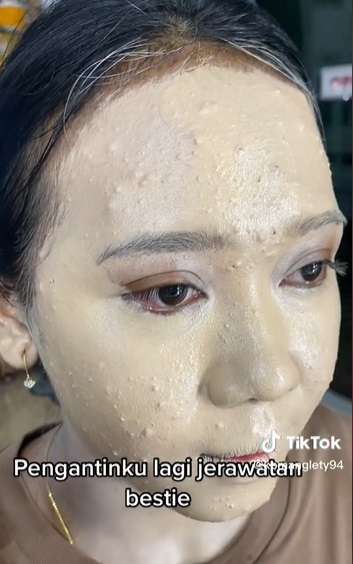 Potret Transformasi Makeup Pengantin yang Alami Jerawat Parah, Awalnya Bikin Deg-degan, Endingnya Malah Bikin Syok!