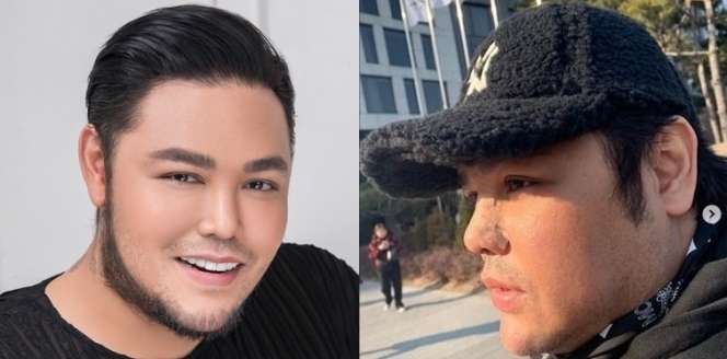 8 Potret Before VS After Artis yang Gagal Lakukan Operasi Plastik, Ada yang Membusuk!