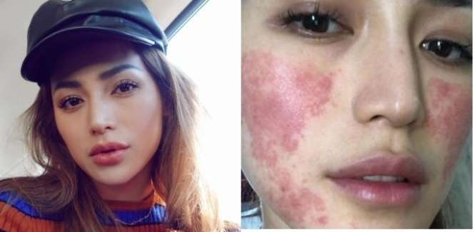 8 Potret Before VS After Artis yang Gagal Lakukan Operasi Plastik, Ada yang Membusuk!