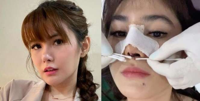 8 Potret Before VS After Artis yang Gagal Lakukan Operasi Plastik, Ada yang Membusuk!