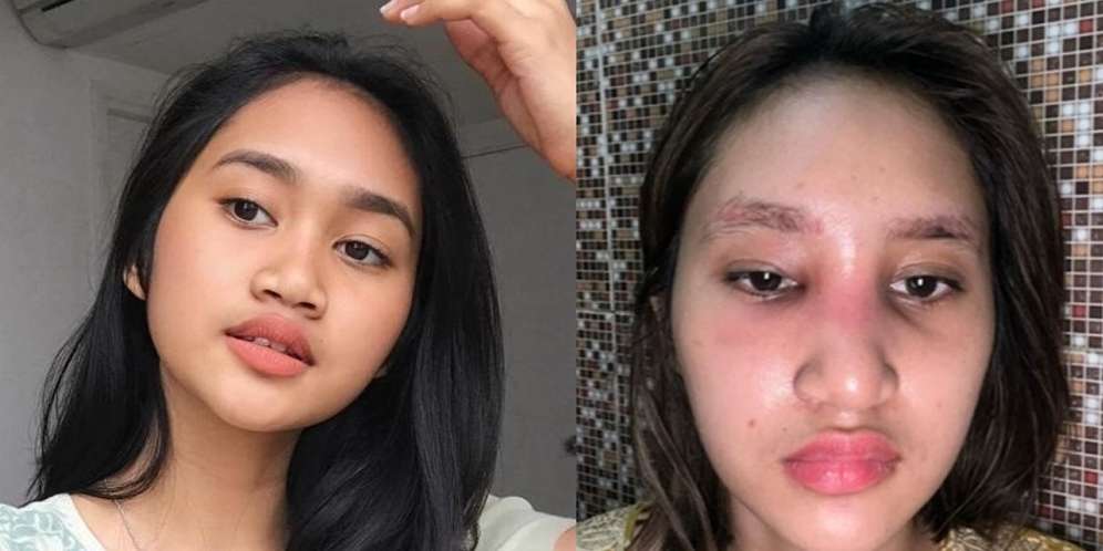 8 Potret Before VS After Artis yang Gagal Lakukan Operasi Plastik, Ada yang Membusuk!