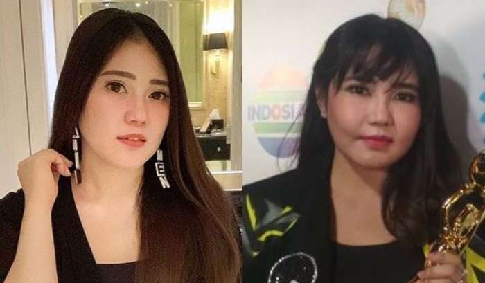 8 Potret Before VS After Artis yang Gagal Lakukan Operasi Plastik, Ada yang Membusuk!