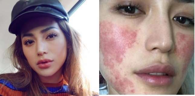 8 Potret Before VS After Artis yang Gagal Lakukan Operasi Plastik, Ada yang Membusuk!