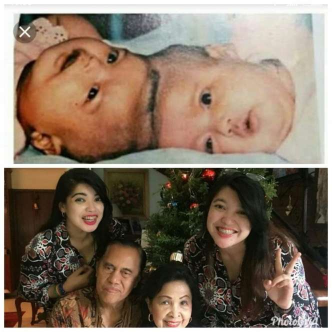 Ingat Bayi Kembar Siam Yuliana-Yuliani? Dulu Kelahirannya Viral Hingga Jadi Sejarah Bidang Kedokteran, Kini Kabar Terbarunya Mengejutkan!