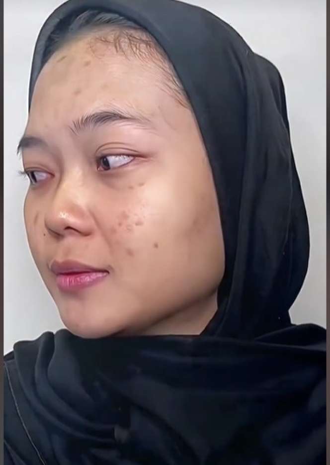 Wajah Pengantin Penuh Jerawat Ini Seketika Berubah Drastis Usai Dirias MUA, Ternyata Begini Hasilnya…