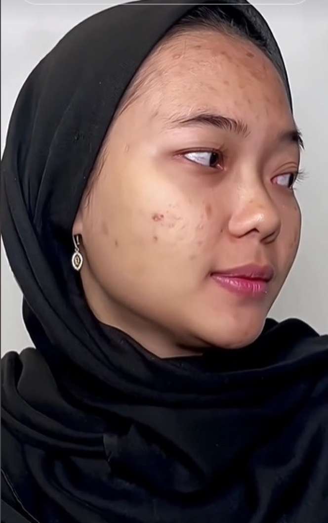 Wajah Pengantin Penuh Jerawat Ini Seketika Berubah Drastis Usai Dirias MUA, Ternyata Begini Hasilnya…