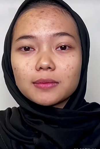 Wajah Pengantin Penuh Jerawat Ini Seketika Berubah Drastis Usai Dirias MUA, Ternyata Begini Hasilnya…