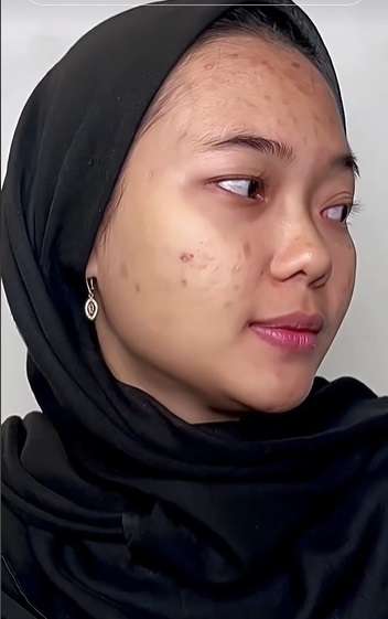 Wajah Pengantin Penuh Jerawat Ini Seketika Berubah Drastis Usai Dirias MUA, Ternyata Begini Hasilnya…